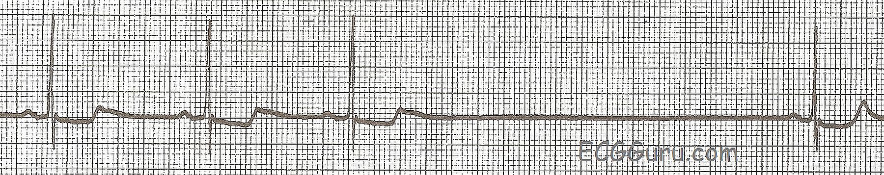 ecg-basics-sinus-pause-sinus-arrest-ecg-guru-instructor-resources